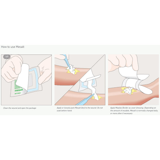 Mesalt® Sodium Chloride Impregnated Dressing