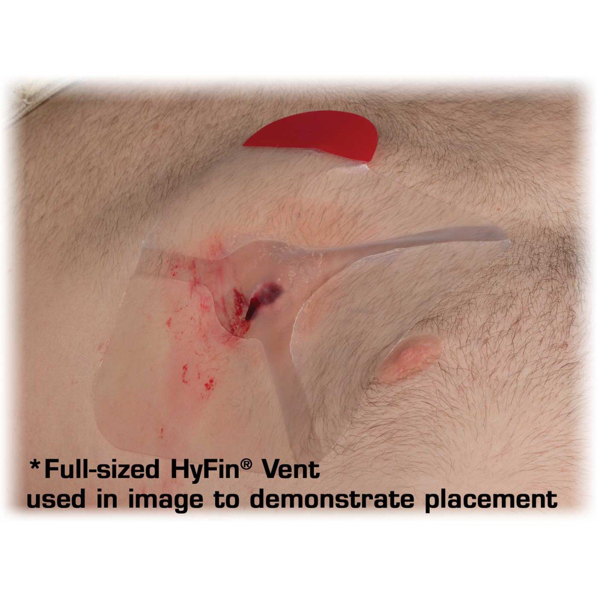 Hyfin® Chest Wound Seal